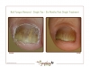 Laser treatment removes unwanted fungus