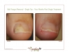 Onychomycosis laser results