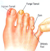 ingrown toenail example