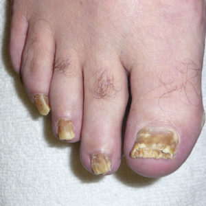 toenail-fungus-extreme-case