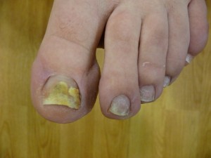 toenail-fungus-mild-case