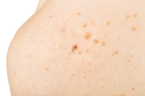 brown spots